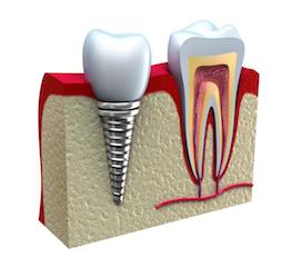 Dental Implants By Covina Dentist Dr Huang